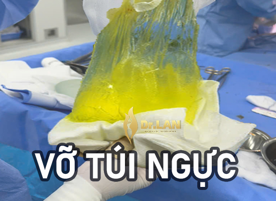 Khi vòng 1 ảnh hưởng sự tự tin sau sinh - Hạnh, 29 tuổi – Bắc Giang chia sẻ kinh nghiệm tháo túi ngực