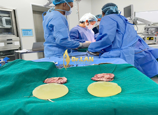 Thay túi ngực có nguy hiểm không?