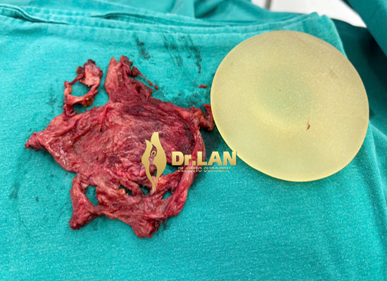 Hình ảnh thực tế túi độn ngực và bao xơ quanh túi ngực được tháo bỏ