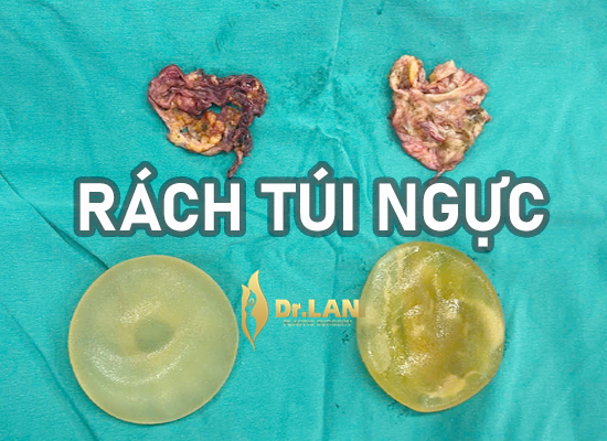 Hình ảnh thực tế túi độn ngực lâu năm biến dạng, xẹp, méo mó và bao xơ túi ngực