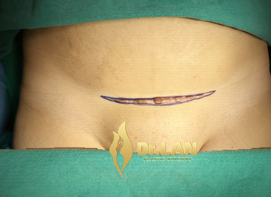 Cắt sẹo lồi sau mổ đẻ khâu thẩm mỹ