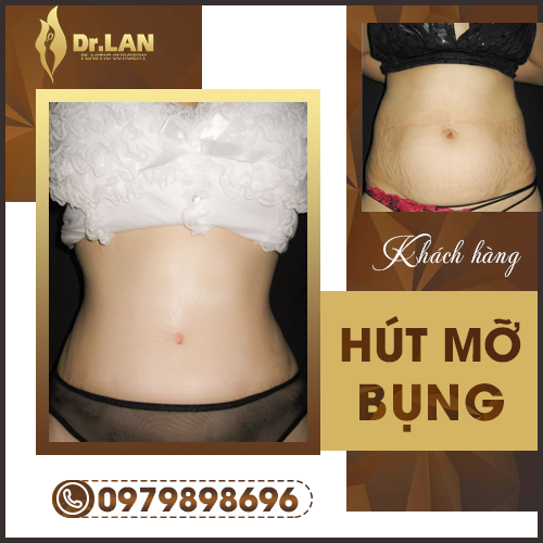 hút mỡ bụng