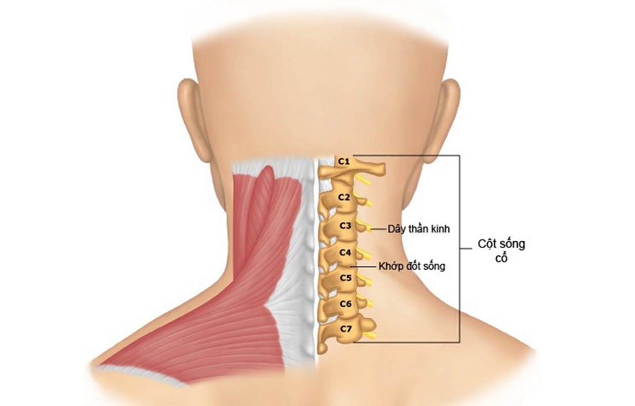 Thoái hóa đốt sống cổ là gì, điều trị thế nào?