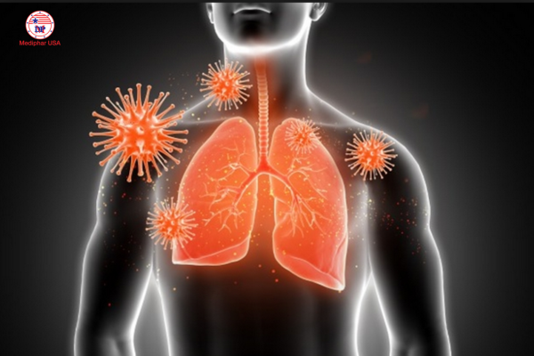 5 triệu chứng của bệnh viêm đường hô hấp cấp thường gặp