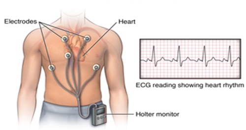 Holter điện tâm đồ là gì?