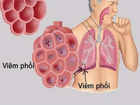 Bộ Y Tế Khuyến Cáo Bệnh Viêm Phổi Lạ Có Nguy Cơ Xâm Nhập Vào Việt Nam