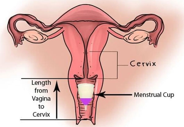 Cốc nguyệt san nằm nhỏ gọn trong âm đạo nên không làm rộng cô bé