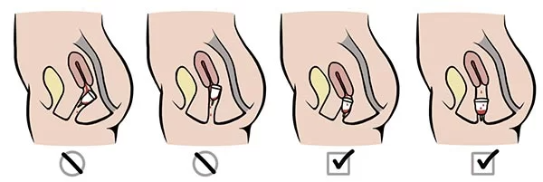 Luyện tập sử dụng cốc nguyệt san trước kỳ kinh nguyệt