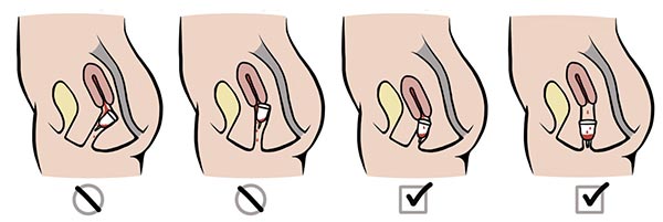 Hình ảnh cốc nguyệt san bị đặt lệch trong tử cung