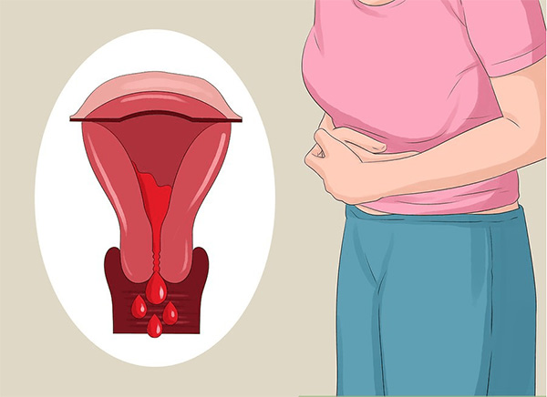 Đau bụng kinh là do trứng rụng và thành tử cung co bóp nên không liên quan đến việc sử dụng cốc nguyệt san