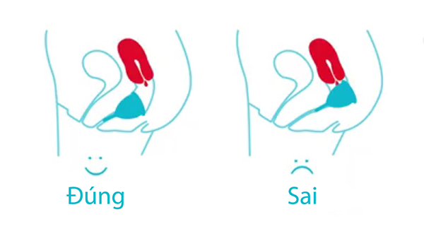 Đặt cốc sai vị trí khiến cốc nguyệt san không hứng được hết dịch kinh, làm dịch kinh chảy ra ngoài
