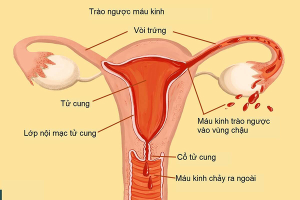 Khi mắc lạc nội mạc tử cung nên tham khảo tư vấn từ bác sĩ trước khi sử dụng cốc nguyệt san