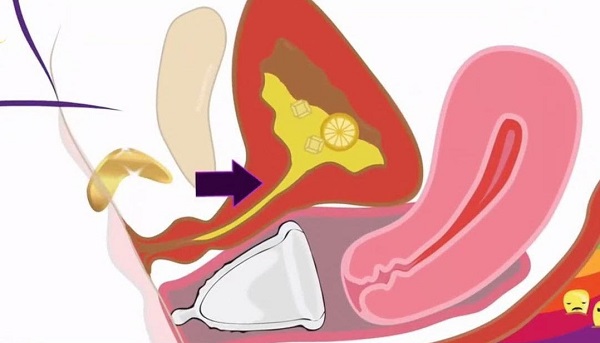 Cốc nguyệt san được đặt ở âm đạo, còn nước tiểu đi qua lỗ tiểu là hai vị trí khác nhau nên sử dụng cốc vẫn có thể đi tiểu bình thường