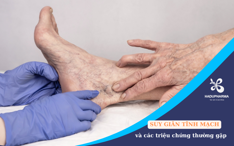 SUY GIÃN TĨNH MẠCH: NGUYÊN NHÂN, TRIỆU CHỨNG VÀ CÁCH PHÒNG NGỪA
