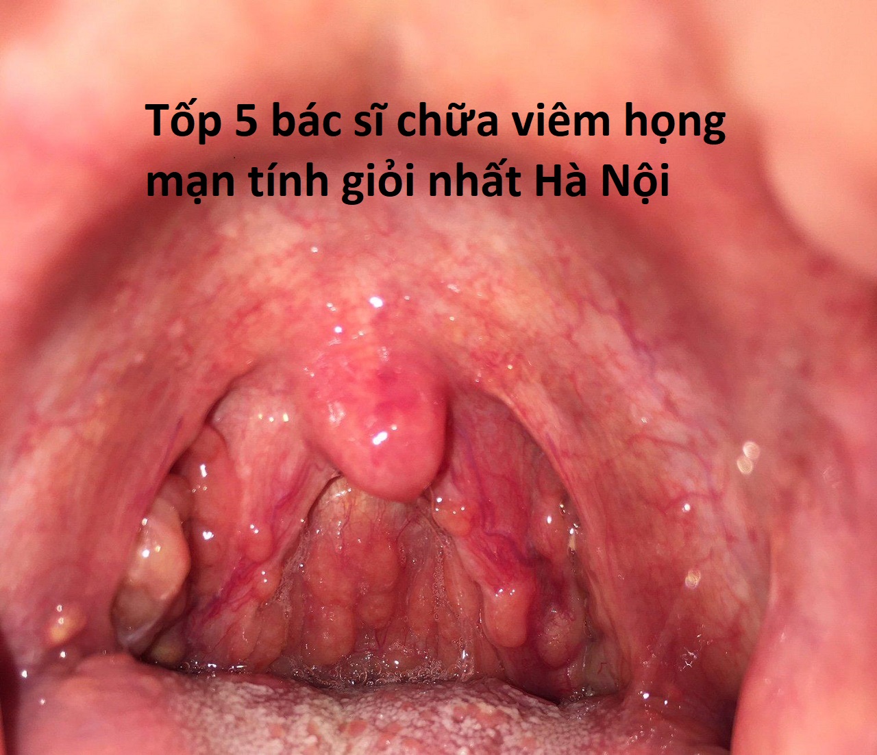 Tốp 5 bác sĩ chữa viêm họng mạn tính giỏi nhất hà nội