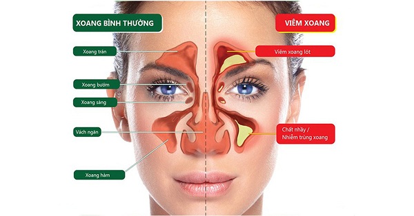 Viêm xoang có chữa khỏi được không?