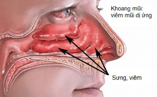 Bệnh viêm mũi dị ứng là gì?