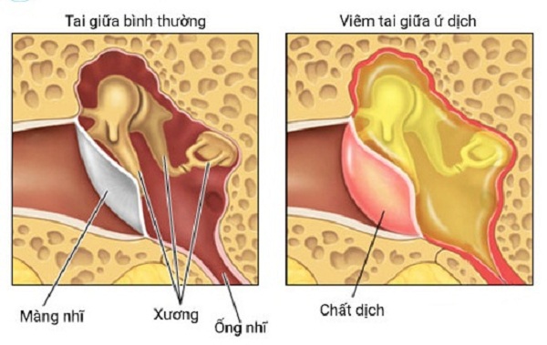 Tai giữa bình thường và tai giữa bị ứ dịch