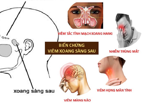 Các biến chứng của bệnh viêm xoang sàng sau mãn tính