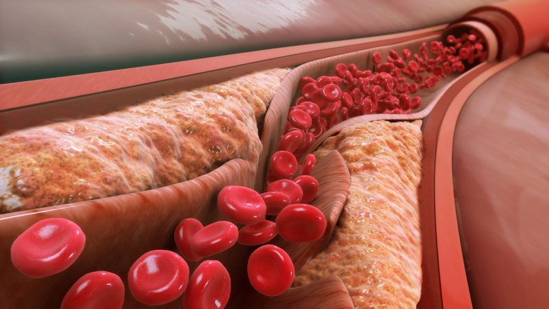 THẾ NÀO LÀ CHOLESTEROL TOÀN PHẦN? Bệnh viện Đa khoa Hòa Bình