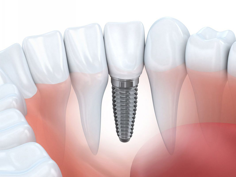 Tìm hiểu về quy trình trồng răng Implant trong phục hình nha khoa thẩm mỹ