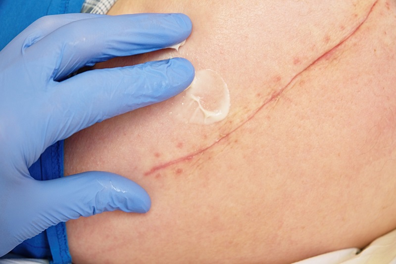 Những điều cần biết về dịch vụ cắt chỉ thẩm mỹ cho vết thương, vết khâu