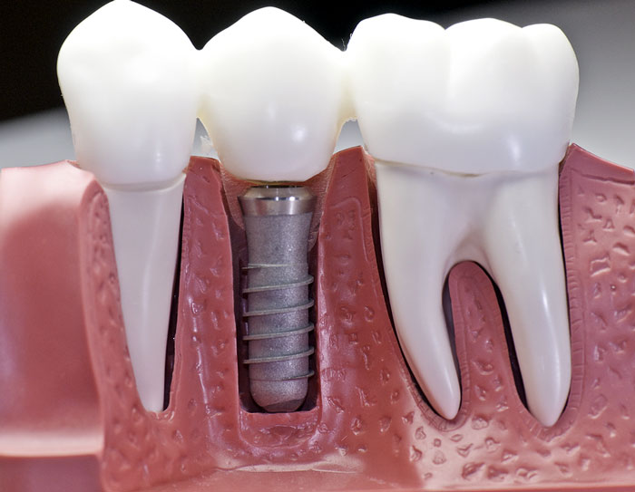 CẤY GHÉP IMPLANT NHA KHOA