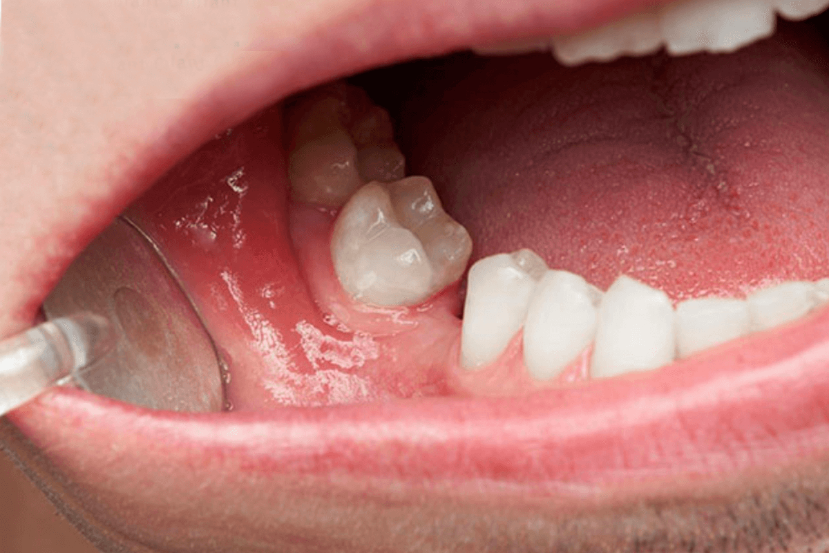 Mất răng hàm số 6 có vấn đề gì không? Mất răng hàm số 6 có niềng được không?