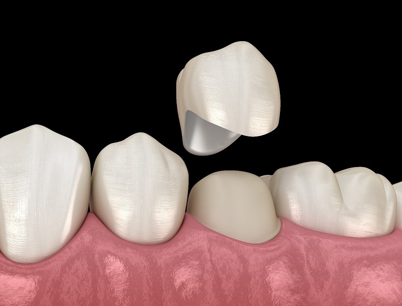Tìm hiểu về phục hình răng sứ thẩm mỹ và phục hình răng sứ bao nhiêu tiền?