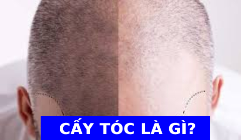 CẤY TÓC LÀ GÌ?