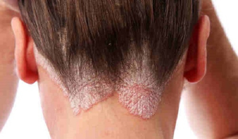 VIÊM CHÂN TÓC LÀ GÌ VÀ CÁCH ĐIỀU TRỊ HIỆU QUẢ