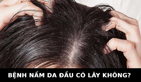 BỆNH NẤM DA ĐẦU CÓ LÂY KHÔNG? KIẾN THỨC THỢ TÓC CẦN NẮM
