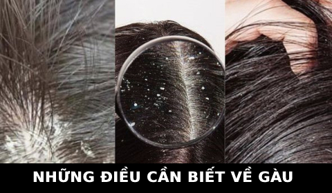 BỆNH GÀU LÀ GÌ? KIẾN THỨC THỢ TÓC CẦN BIẾT