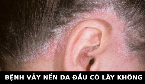 BỆNH VẢY NẾN DA ĐẦU CÓ LÂY KHÔNG? (KIẾN THỨC THỢ TÓC CẦN BIẾT)