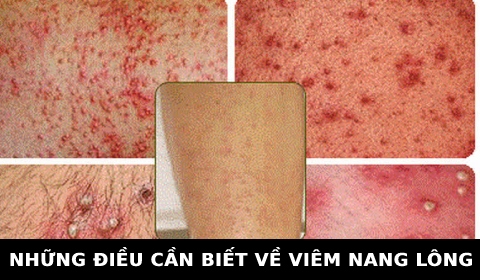 VIÊM NANG LÔNG. KIẾN THỨC THỢ TÓC CẦN NẮM