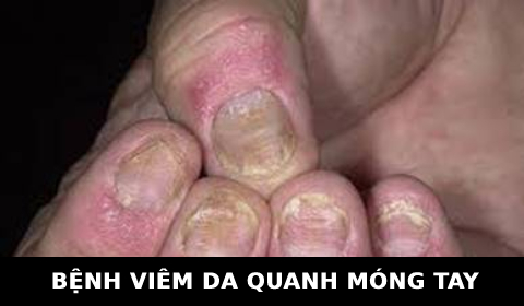 VIÊM DA QUANH MÓNG. KIẾN THỨC CHO THỢ TÓC