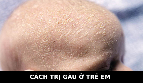 GÀU Ở TRẺ EM VÀ CÁCH TRỊ