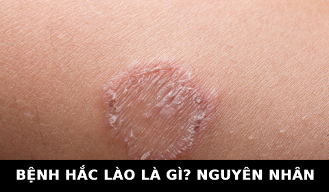 BỆNH HẮC LÀO. KIẾN THỨC THỢ TÓC CẦN BIẾT