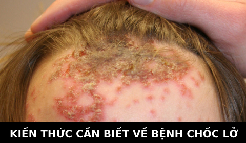 BỆNH CHỐC LỞ. KIẾN THỨC THỢ TÓC CẦN NẮM