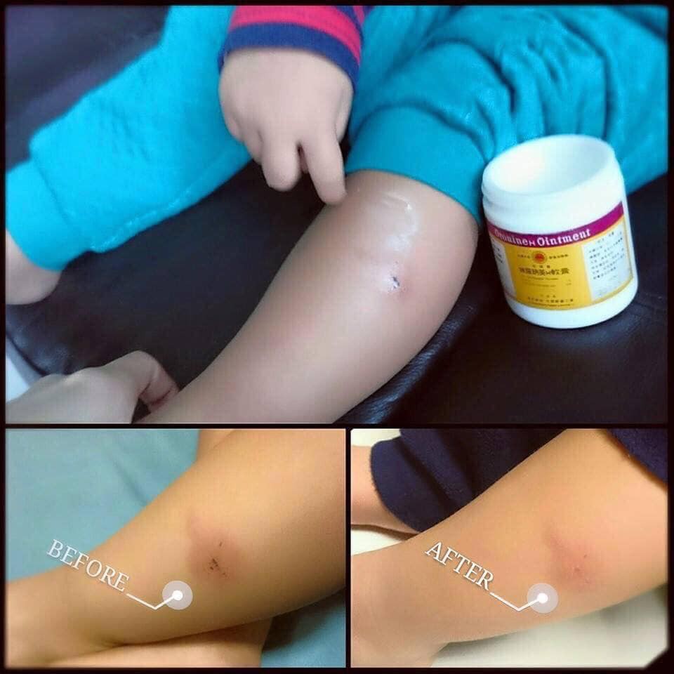 KEM BÔI LÀNH VẾT THƯƠNG ORONINE CỦA NHẬT (LỌ 30GR)