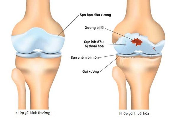 Thoái Hoá Khớp Gối Và Loãng Xương | Cách Phân Biệt 2 Bệnh Lý Thường Gặp Ở Người Cao Tuổi