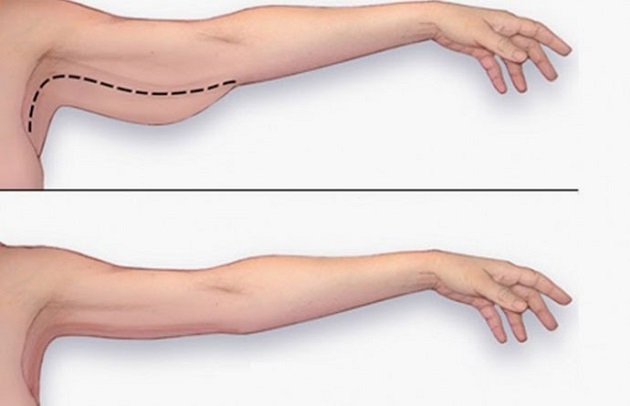 Tập  plank có bị to bắp tay không