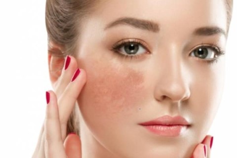 Mách cho bạn bí quyết trị nám tại nhà hiệu quả nhất Mách cho bạn bí quyết trị nám tại nhà hiệu quả nhất
