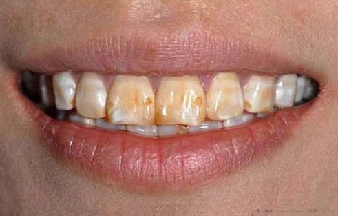 CÁCH CHĂM SÓC RĂNG MIỆNG SAU KHI BỌC RĂNG SỨ Nha Khoa Nụ Cười Đà Lạt