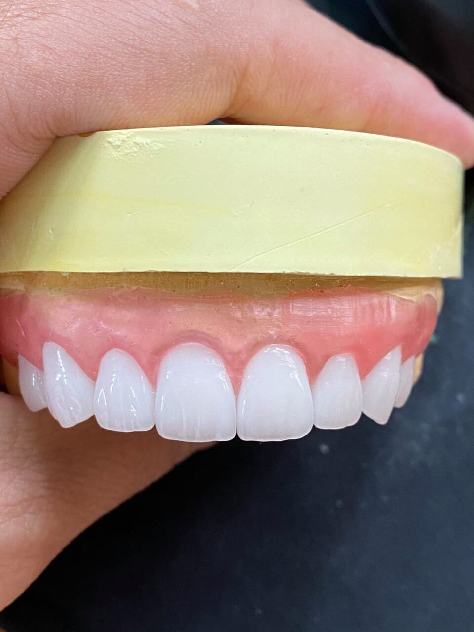 Răng cửa đẹp có 5 tiêu chuẩn đánh giá là gì