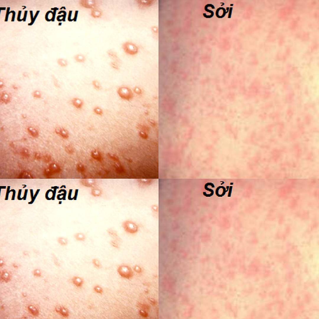 2 Công Thức Cho Mùa Hè Với Những B.ệnh Phổ Biến