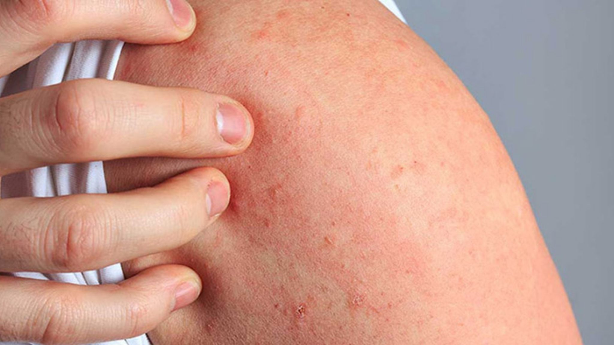 Người có tiền sử dị ứng với CoQ10 hoặc phụ gia