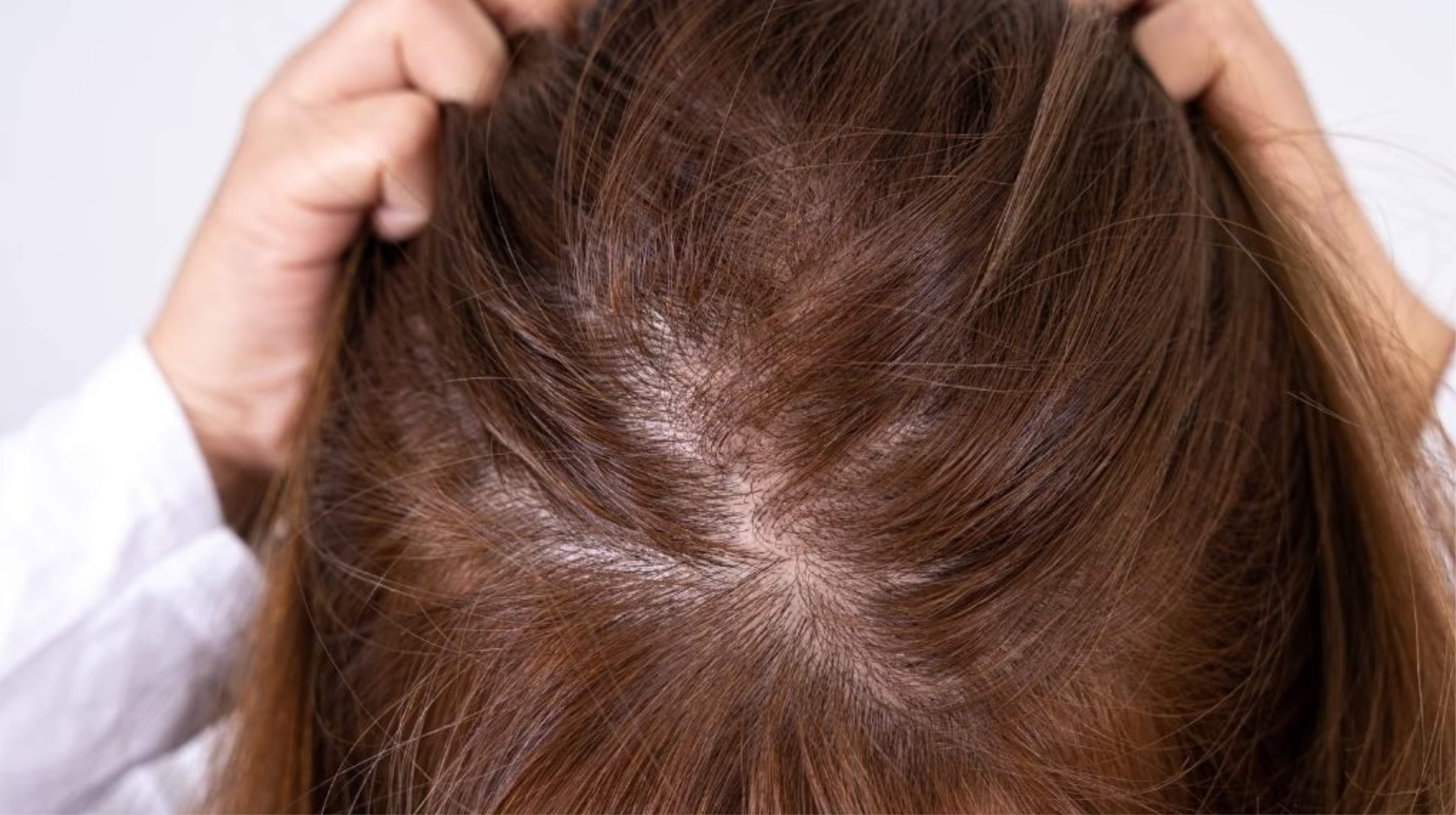 Người có tóc yếu, mỏng, mọc chậm