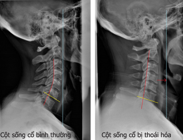 Thoái hóa đốt sống cổ: nguyên nhân, dấu hiệu, cách khắc phục Y TẾ ...