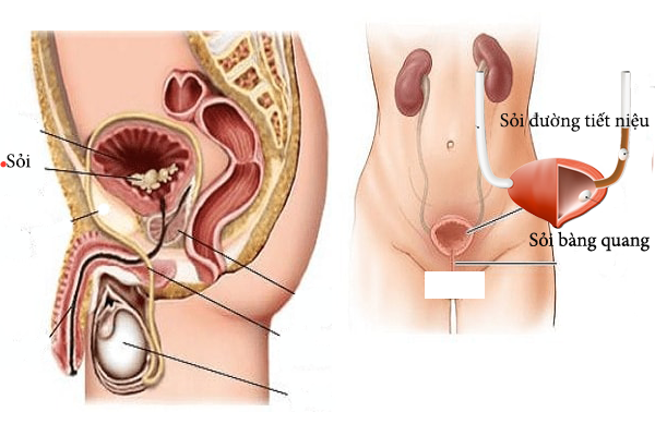 TRIỆU CHỨNG, BIỂU HIỆN CỦA SỎI BÀNG QUANG